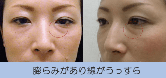 脱脂リポ法