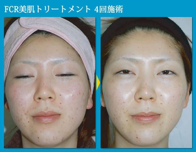 Fcr美肌トリートメント スキンケア 美肌 銀座みゆき通り美容外科大阪院 Fcr美肌トリートメント スキンケア 美肌 銀座みゆき通り美容外科大阪院