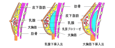 豊胸手術バッグ挿入法イラスト 豊胸手術バッグ挿入法イラスト